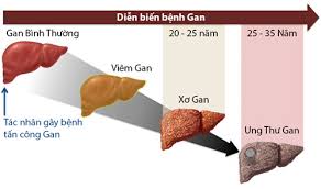 diễn biến bệnh gan